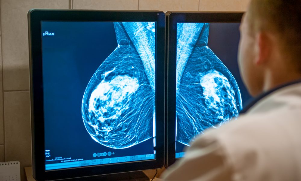 “Promising” breast cancer treatment may save 10,000 lives a year