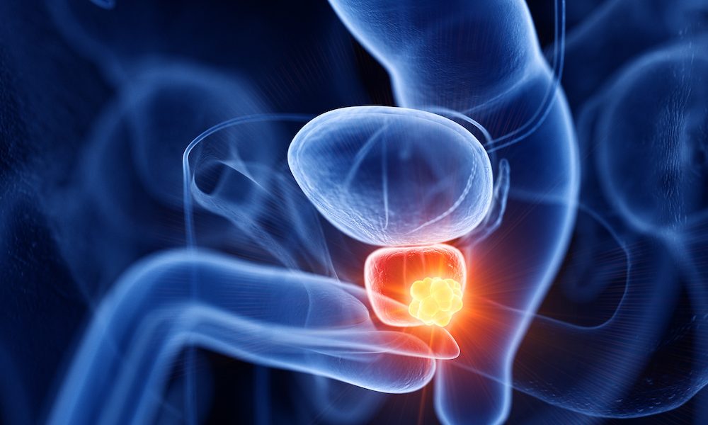 Men with prostate cancer have higher risk of serious blood clots