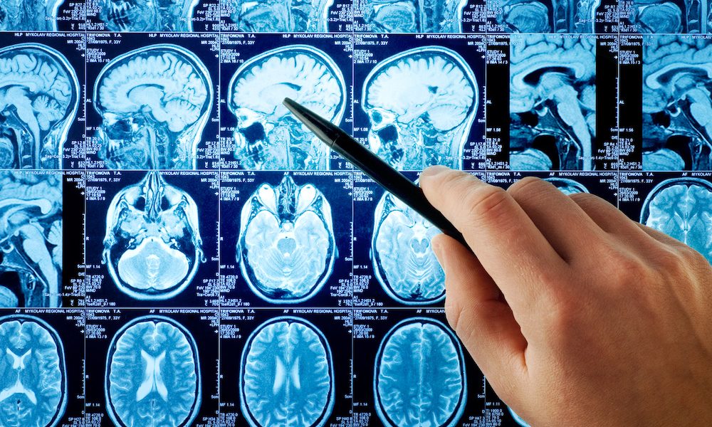 Knowing you have a brain aneurysm may raise anxiety risk