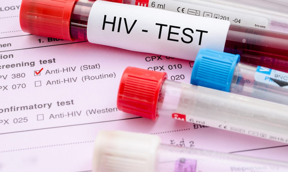 HIV speeds up ageing process soon after infection – study