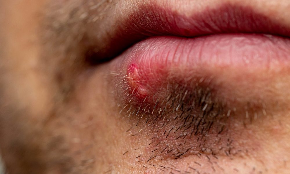 Varicella and Herpes viruses may trigger Alzheimer’s