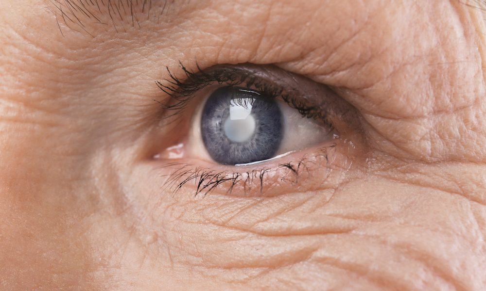 People with Glaucoma have higher risk of Alzheimer’s disease, study finds