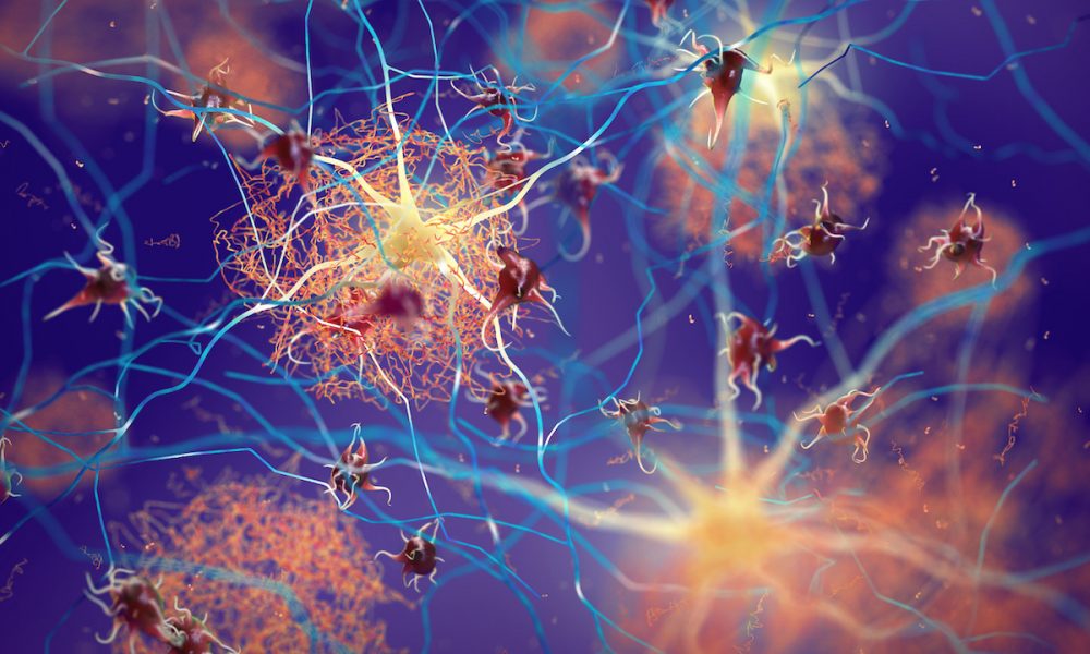 New technology offers fresh insights into Alzheimer’s disease