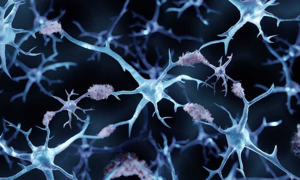 Test could detect Alzheimer’s more than three years before diagnosis