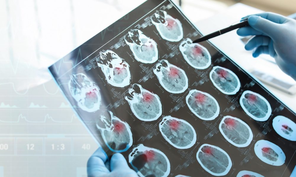 Weight loss drug slows Alzheimer’s decline, study finds