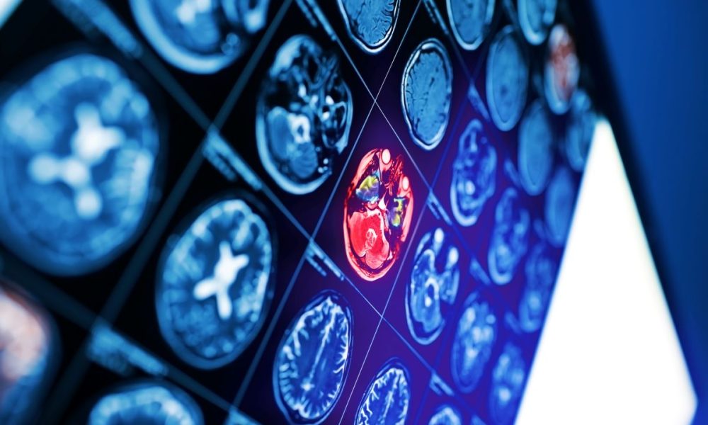 Novel stroke treatment receives new US patent