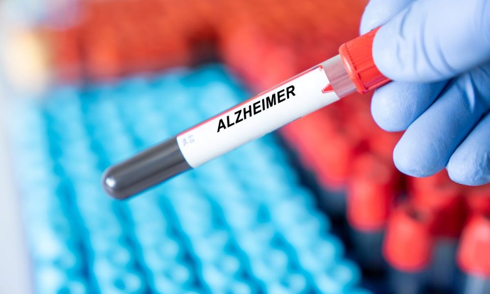 Trial of Alzheimer’s immunotherapy vaccine begins