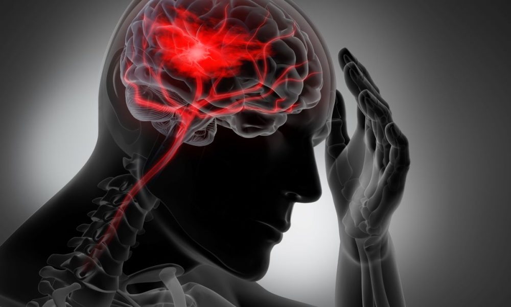 Genetic test should be new standard of care in UK for stroke patients