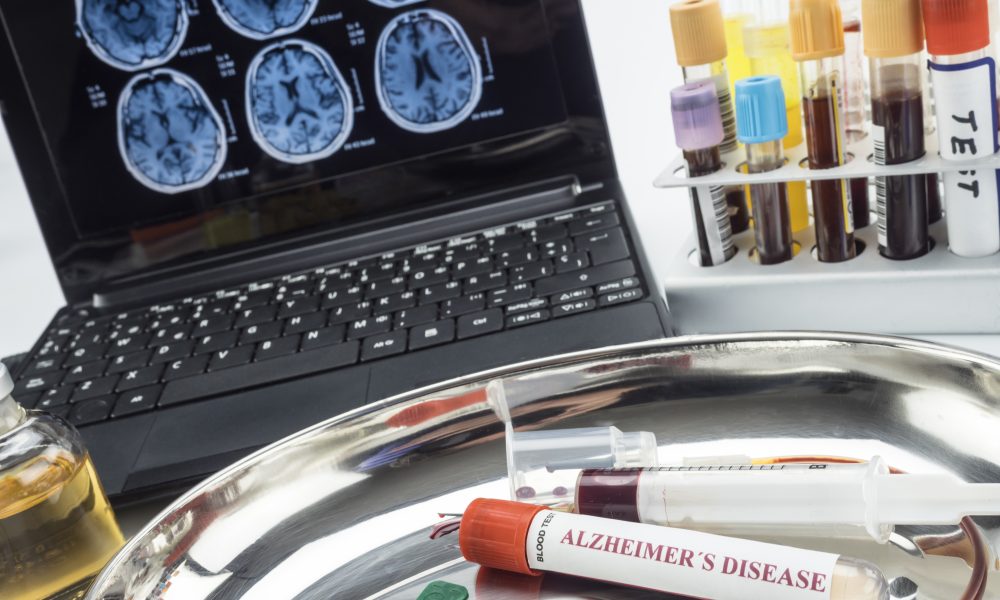 New Alzheimer’s blood test shows 95 per cent accuracy in detecting early memory problems