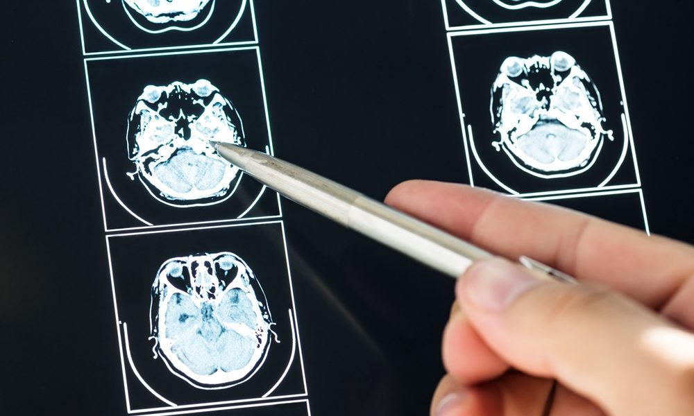 Participants sought for ‘groundbreaking’ dementia study