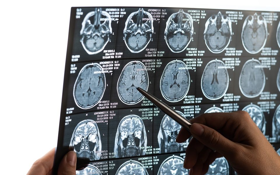 Researchers uncover potential new early warning sign for Alzheimer’s