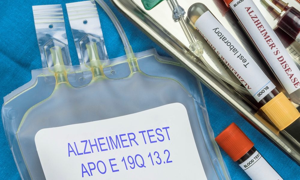 Glasgow clinic launches Alzheimer’s detection test