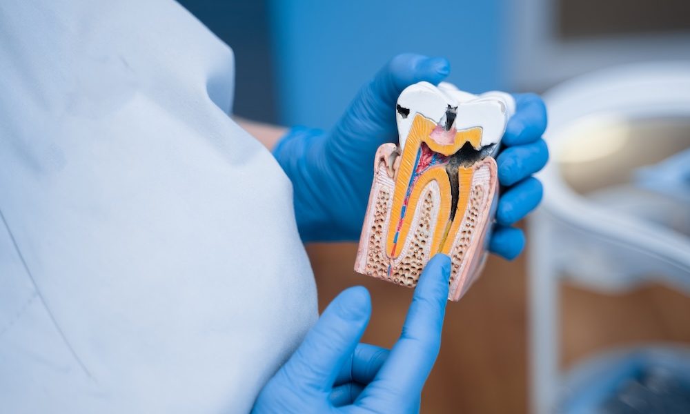 Root canal treatment may lower heart disease and diabetes risk