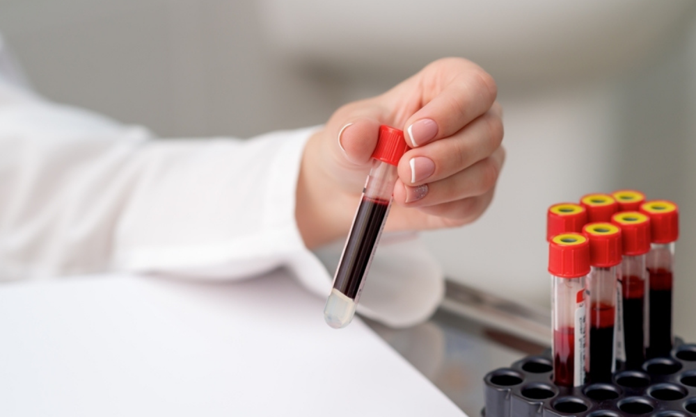 First blood test for Alzheimer’s in primary care