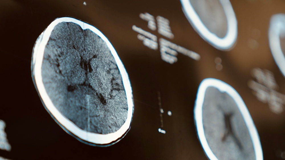 Cross-sectional brain CT images displayed on film against a dark background, showing multiple circular slices with white outlines.
